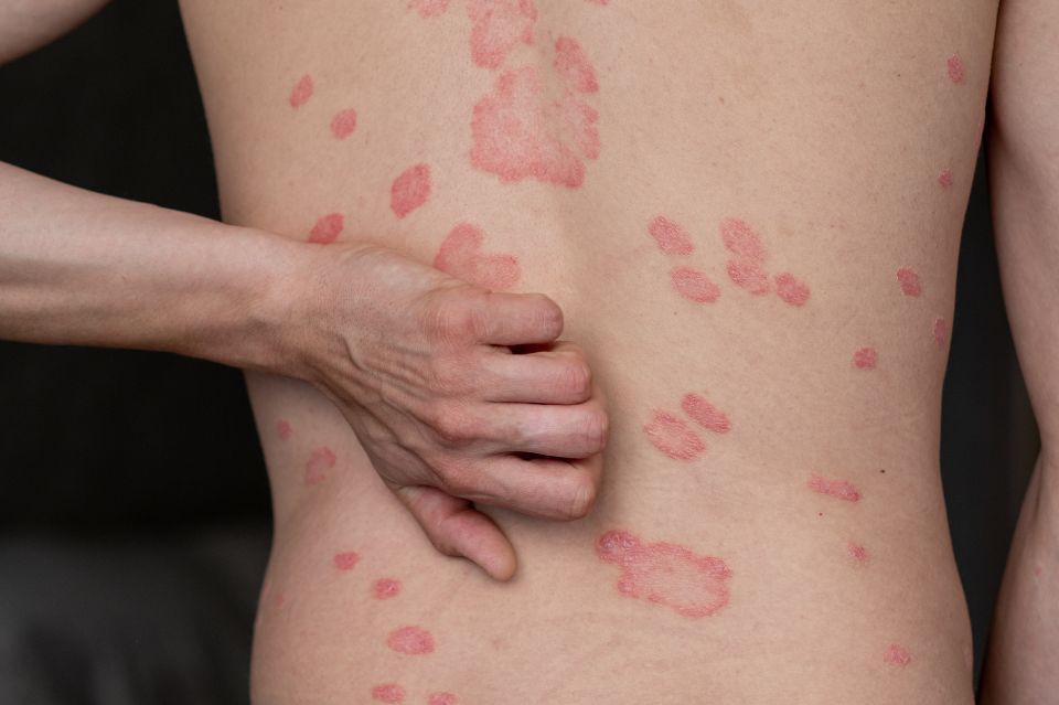 Psoriasis og cbd: Kan cannabis-olie være svaret?